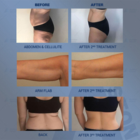 Appareil de remodelage corporel, machine de massage à rouleaux sous vide, traitement de la cellulite, machine de beauté pour amincir le corps