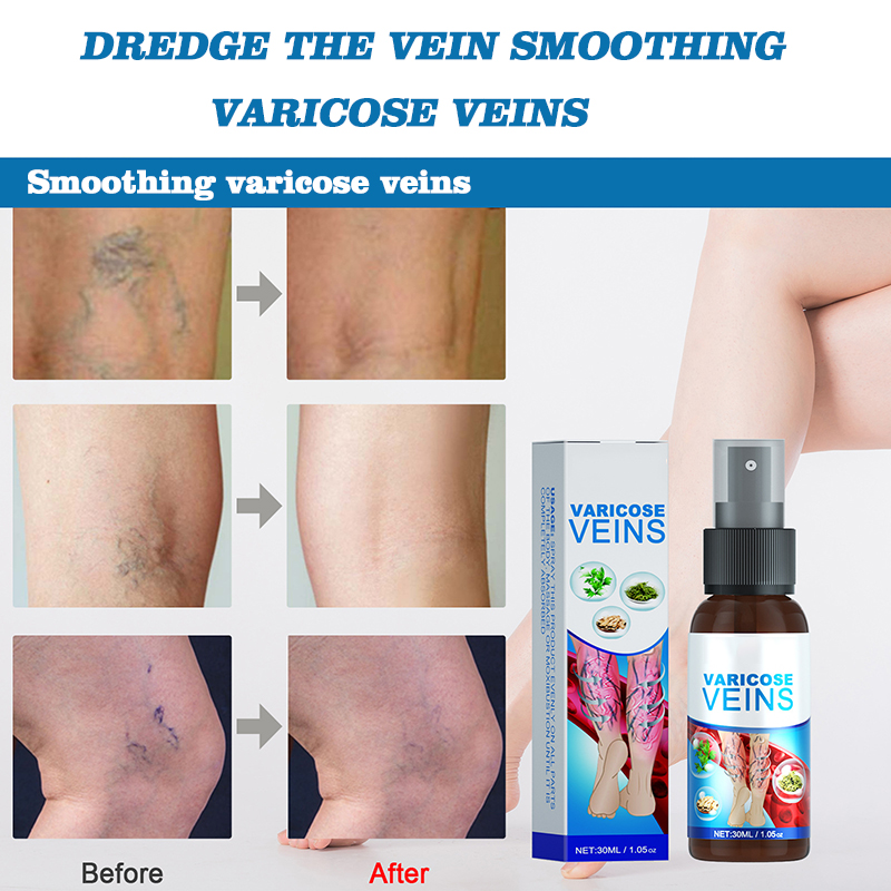 hot sell varicose veins remover treatment spray for veins earthworm leg torment 30ml
