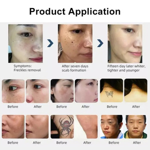 Appareil de soin personnel Faling a Pico 1064 532 1320 nm pour le nettoyage des tatouages, des cicatrices, des taches pigmentaires, des sourcils, des soins de la peau, des soins du visage, à usage domestique - Product Image 6