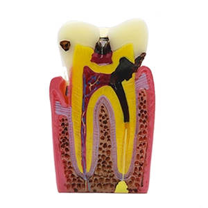 Estudio directo de fábrica <span class=keywords><strong>dentista</strong></span> anatómico oral cariado diente común enfermedades dentales modelo de comparación - Product Image 2
