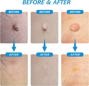 Safety 2 in 1 <strong>Skin</strong> <strong>Tag</strong> <strong>Removal</strong> Kit <strong>Skin</strong> Mole Wart Remover 2mm to 8mm <strong>Skin</strong> <strong>Tag</strong> Remover Pen With Cleansing Swabs and Repair <strong>Patch</strong> - Product Image 5