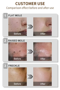 Machine professionnelle de suppression des taches cutanées et des grains de beauté, stylo plasma à jet pour le nettoyage de la peau, en promotion - Product Image 6