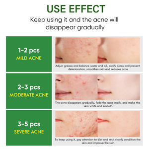 Crème réparatrice pour la peau en marque propre, <span class=keywords><strong>meilleur</strong></span> traitement contre l'acné, crème <span class=keywords><strong>anti</strong></span>-acné, crème pour éliminer les cicatrices d'acné - Product Image 4