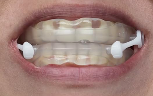 Dispositif anti-ronflement 2026 à avancement <span class=keywords><strong>mandibulaire</strong></span> – Protège-dents réglable sans BPA avec technologie de sommeil silencieux - Product Image 4