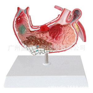 Modelo anatómico gástrico, modelo de estómago con enfermedades, modelo de demostración de enfermedades gástricas, modelo de estómago patológico, humano - Product Image 1