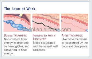 Équipement médical <span class=keywords><strong>de</strong></span> traitement <span class=keywords><strong>de</strong></span> <span class=keywords><strong>maladie</strong></span> <span class=keywords><strong>vasculaire</strong></span> <span class=keywords><strong>de</strong></span> laser <span class=keywords><strong>de</strong></span> diode <span class=keywords><strong>de</strong></span> 980nm 1470nm 47w pour le retrait <span class=keywords><strong>de</strong></span> vaisseaux sanguins et le traitement d'EVLT - Product Image 6