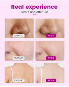 เครื่องดูดสิวเสี้ยนระบบสุญญากาศสูง 90-100kPa สำหรับทำความสะอาดรูขุมขนอย่างล้ำลึก พร้อมออกซิเจนเจ็ท ลดเลือนริ้วรอย - Product Image 6