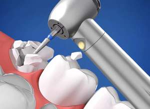 หัวกรอฟันแบบ3ทางหัวฉีดเซรามิกกังหันไฟฟ้า - Product Image 5