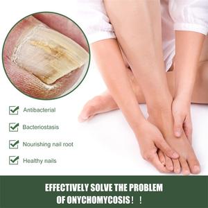 Solution pour l'élimination des champignons des ongles de pied South Moon, essence pour le traitement des champignons des ongles, stylo laser diode, kit - Product Image 2