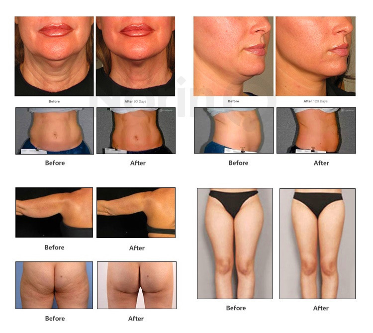 4D 60000 Shots 11 Lines Anti Wrinkle Face Lift Skin Tightening Body Slimming 3D 4D beauty machine