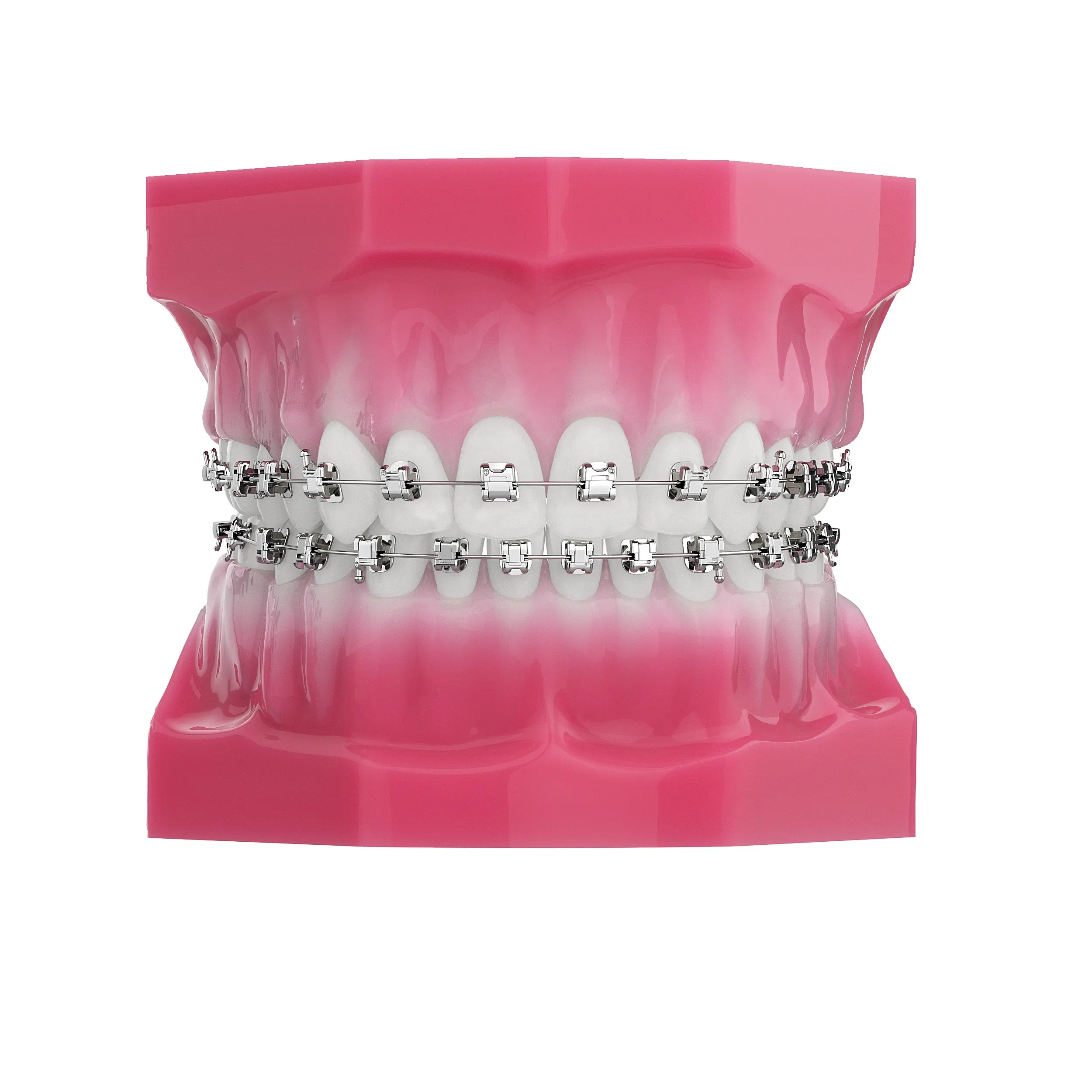Progettazione di superfici Standard per staffe ortodontiche auto-collegamento in metallo e dispositivi ortodontici-macchinari orali