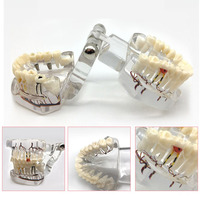 Implants dentaires pathologiques en PVC transparent avec modèles de nerfs dentaires à des fins d'enseignement médical et dentaire CE/ISO