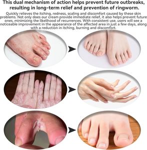 Balsamo al Miele e Tea Tree a Marchio Privato, Crema Naturale per Mani e Piedi, Trattamento per Tinea Versicolor, Piedi Pruriginosi, Glutei, Psoriasi, Eruzioni Cutanee, Eczema - Product Image 2