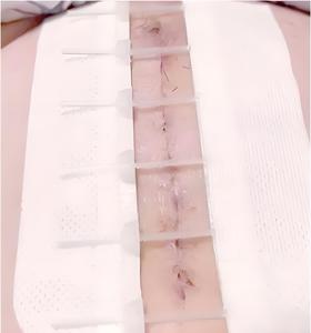 مجموعة إغلاق جروح طوارئ شفافة ضمادات فراشة وتضميد شريط خياطة للتمزق وشقوق - Product Image 4