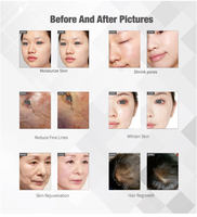 Appareil de mésothérapie multifonctionnel sans aiguille certifié CE, machine pour le soin de la peau du visage à vendre, technologie d'électroporation