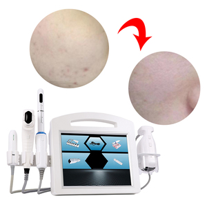 Instrumento de Belleza 5 en 1 para Reafirmar, Levantar, Disolver Grasa, Moldear el Cuerpo y Antiarrugas para Mujeres - Product Image 2