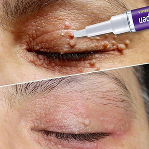 Stylo anti-verrues EELHOE, formule naturelle, non irritant, cicatrisation rapide, pour éliminer les excroissances cutanées et les grains <span class=keywords><strong>de</strong></span> beauté - Product Image 3