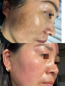 Kit de Eliminación de Manchas Oscuras y Melasma, Esponja Bio con Microagujas de Algas, <span class=keywords><strong>Gel</strong></span> Exfoliante para Manchas Negras y <span class=keywords><strong>Gel</strong></span> Calmante y Refrescante para la Piel - Product Image 3
