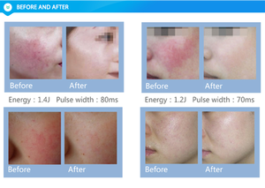 Máquina Láser de Diodo profesional de 980nm, láser, pierna Facial, Araña, vena, tratamiento vascular varicoso a la venta - Product Image 6