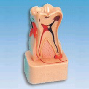 Ada รูปแบบการสลายตัวของฟันทางการแพทย์ขององค์กรและรอยโรคฟันรูปแบบการสลายตัวทางพยาธิวิทยาที่ครอบคลุม - Product Image 2