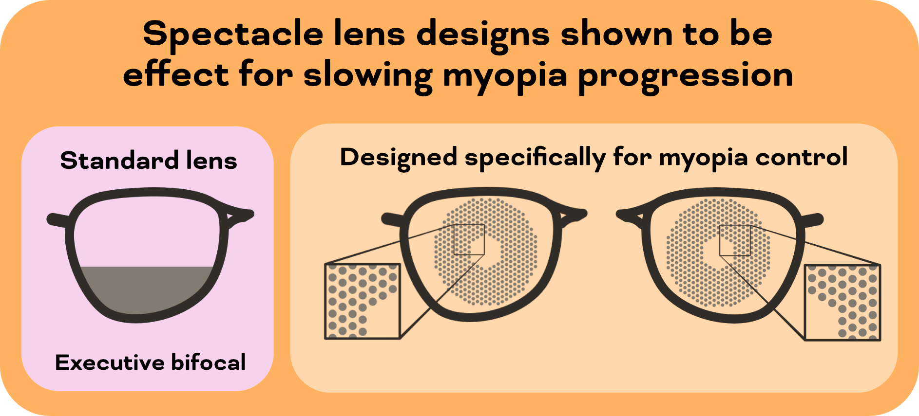 Myopia Progression Short Sighted Glasses Myopia Control