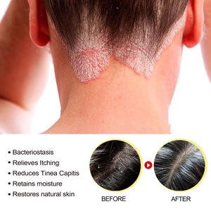 Shampoo au soufre South Moon pour les pellicules, rafraîchissant, soulageant les démangeaisons, réduisant la tinea capitis, meilleur shampooing pour le cuir chevelu séborrhéique - Product Image 5