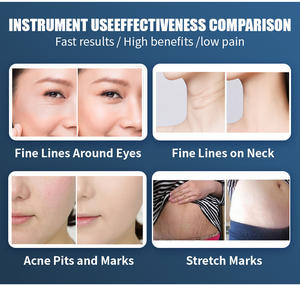 <span class=keywords><strong>Appareil</strong></span> de <span class=keywords><strong>Microneedling</strong></span> RF le Plus Vendu pour l'Élimination des Cicatrices, le Traitement des Cernes et la Réparation des Peaux Sensibles - Product Image 5