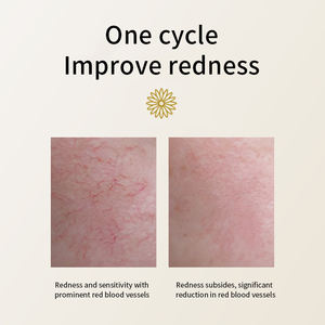 Sérum Réparateur de Barrière Cutanée OEM à la Camomille Anti-Rougeurs, Anti-Inflammatoire, Apaisant pour la Rosacée, Soulagement des Démangeaisons, Soin <span class=keywords><strong>Visage</strong></span> Peaux Sensibles - Product Image 3