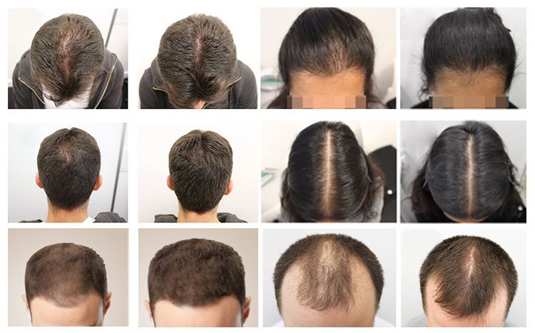LED Hair Growth Treatment Machine Is Used To Stimulate Hair Regeneration And Improve Hair Condition.