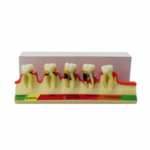 Odontologia Modelo De Educação De Dentes De Doença <span class=keywords><strong>Periodontal</strong></span> Para Treinamento Modelo De Doença <span class=keywords><strong>Periodontal</strong></span> Dentária - Product Image 6