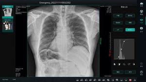 Appareil de radiographie portable <span class=keywords><strong>Rx</strong></span> abordable 14*17/17*17, détecteur numérique à panneau plat pour radiographie, équipement de radiographie - Product Image 4