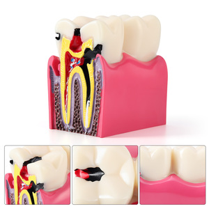 Azdent modello di insegnamento dentale 6 volte carie due lato contrasto anatomico per l'educazione del paziente e spiegazione - Product Image 5