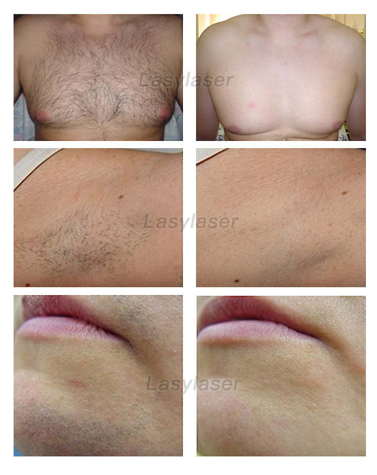 Diode laser 808nm epilator laser hair removal machine 755 808 1064 three wavelength laser hair removal machine beauty instrument