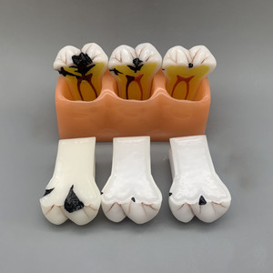 Modèle de classification de la carie dentaire quadruple Science médicale Maladie de la carie dentaire - Product Image 1