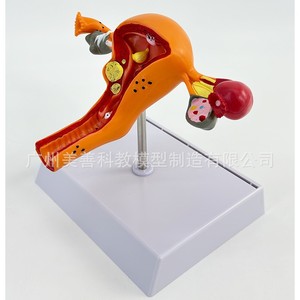 Modèle utérin pathologique féminin ; structure anatomique de l'ovaire et de l'utérus en obstétrique et gynécologie ; avancé - Product Image 2