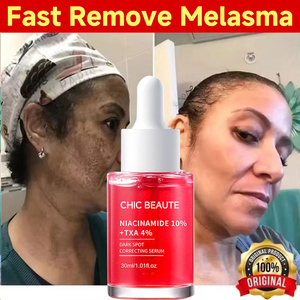<span class=keywords><strong>CHIC</strong></span> BEATUE Stock Niacinamida 10% Sérum Químico Corrector de Manchas Oscuras, Blanqueador y Antiarrugas, Reduce las Arrugas y Minimiza los Poros - Product Image 3