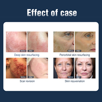 Mesin Laser Fraksional CO2 Kekuatan Tinggi Seaheart Professional dengan Tabung Logam RF 10600nm untuk Peremajaan dan Perawatan Kulit