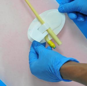 Perlengkapan Medis Jarum Indwelling Perangkat Pengaman Tabung Nasogastrik Sekali Pakai Perangkat Fiksasi Kateter Kustom - Product Image 3