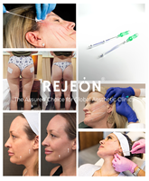 S REJEON – Prix avantageux, qualité stable – Fils PDO MOMO 2-en-1 sûrs, 500g, 26mm, 27mm pour l'académie de formation en esthétique médicale / Lifting du visage