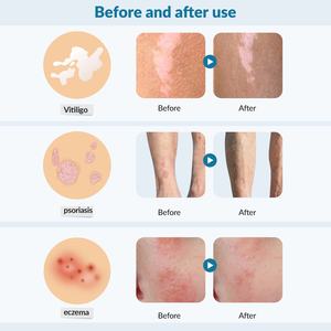 Lámpara de Vitiligo Ultravioleta de 308 nm, Láser B Zjkclasertherapy, Terapia LED, Eczema, <span class=keywords><strong>Dermatitis</strong></span> Atópica, Excimer UVB de 308 nm, 40 Mwcm2 - Product Image 2