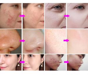 Appareil de mésothérapie manuel Dermashine PRO à 9 aiguilles avec aspiration sous vide pour le visage et le nez, étanche - Product Image 6