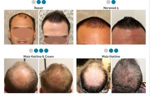 Equipo Médico de Alta Calidad para el Crecimiento del Cabello LLLT KN-8000A para la <span class=keywords><strong>Alopecia</strong></span> Androgenética y la <span class=keywords><strong>Alopecia</strong></span> <span class=keywords><strong>Areata</strong></span> - Product Image 5