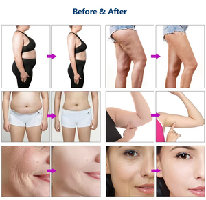 เครื่องฟื้นฟูผิวอเนกประสงค์ 40k สำหรับสลายไขมัน ลดเซลลูไลท์ พร้อมหัวเปลี่ยนหลากหลายสำหรับใช้ในบ้าน - Product Image 5