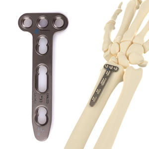 CANWELL Placa de Bloqueo de Titanio para <span class=keywords><strong>Radio</strong></span> <span class=keywords><strong>Distal</strong></span>, Implante Ortopédico Volar para Muñeca, Trauma Óseo, Fractura, Proveedores, Fabricante, CE ISO - Product Image 2