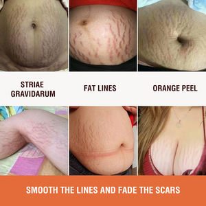 Crème anti-vergetures pour le corps, lotion naturelle contre les vergetures, les cicatrices, soin de la peau, efficace - Product Image 2