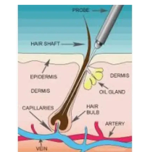 Salon de beauté d'équipement d'<span class=keywords><strong>épilation</strong></span> électrolytique-aiguilles électrolytiques pour l'<span class=keywords><strong>épilation</strong></span>, dispositif d'<span class=keywords><strong>épilation</strong></span> électrolytique chaud - Product Image 5