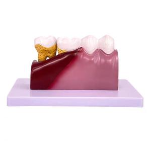 Modèle de caries dentaires pathologiques, modèle pédagogique complet de pathologie dentaire, modèle anatomique du dôme dentaire - Product Image 6
