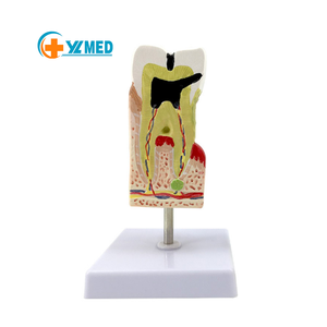 PVC đào tạo nha khoa con người bệnh lý răng sâu răng Mở rộng giải phẫu chính xác mô hình sâu răng cho các bài thuyết trình nha khoa - Product Image 1