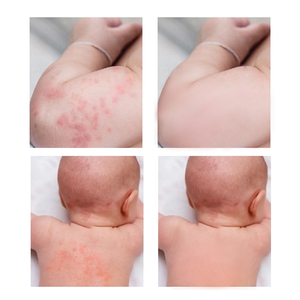Crème réparatrice complète pour érythème fessier du bébé, traitement du psoriasis, bonne crème pour l'eczéma, crème pour le psoriasis, herbes pour l'eczéma - Product Image 6