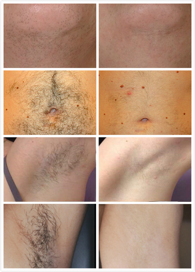 Portable 808nm Diode Laser Hair Removal Beauty Salon Equipment